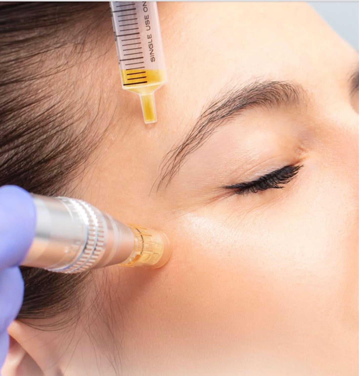 Microneedling